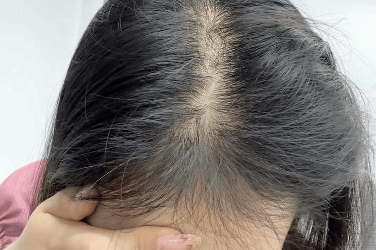 脂溢性脱发什么症状