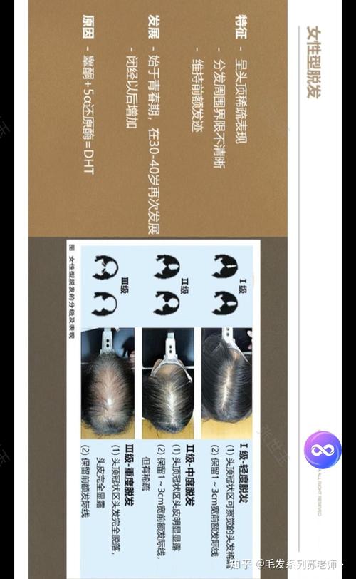 什么是雄性脱发