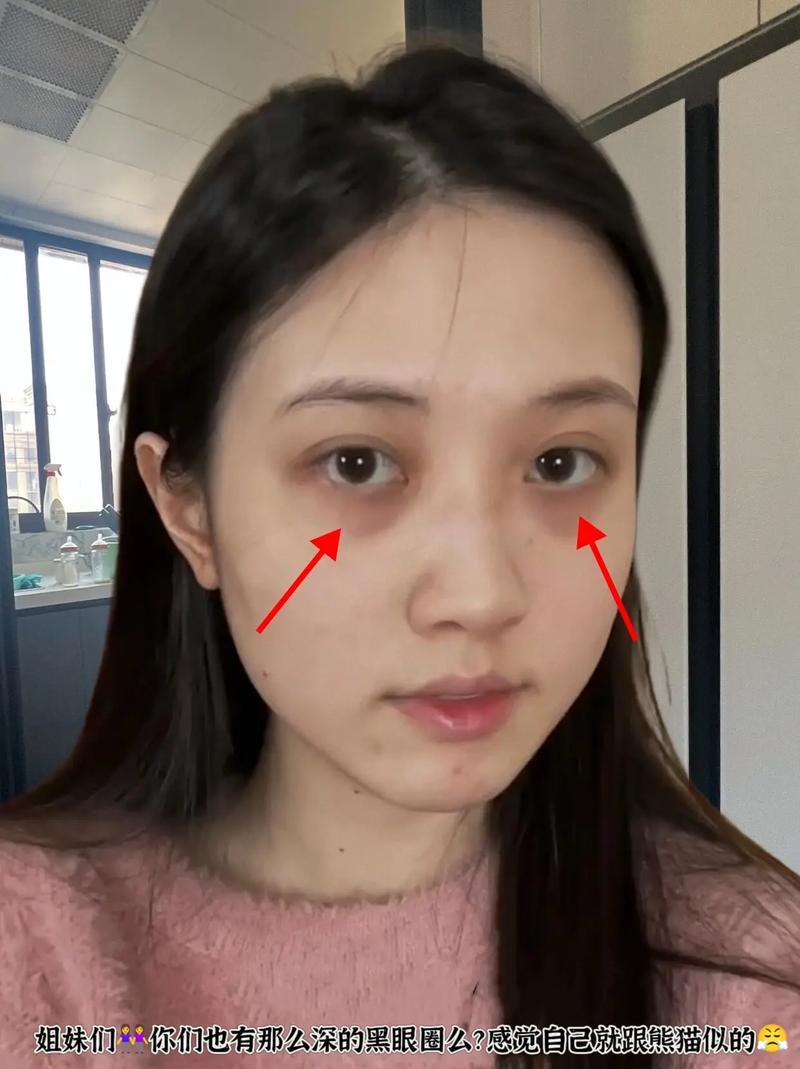 眼袋黑为什么