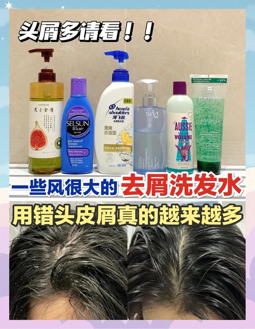 有头皮屑用什么洗发水