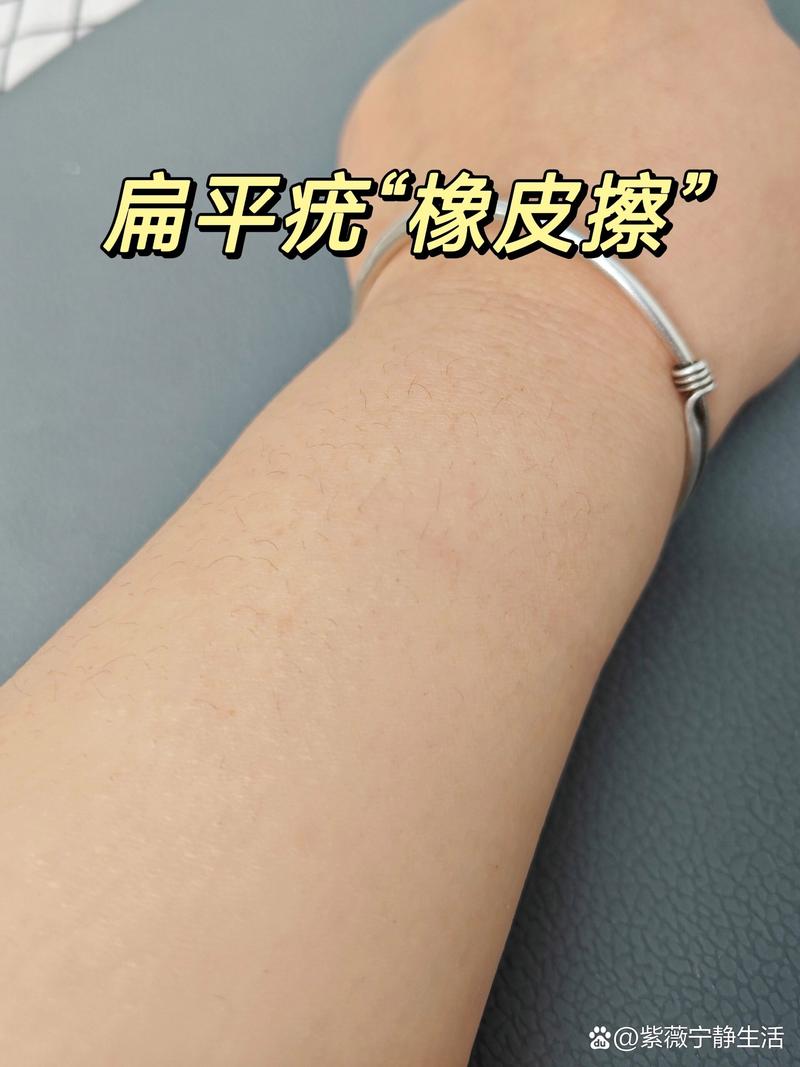 扁平疣是什么东西