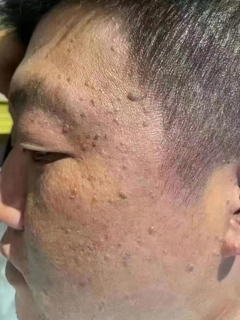 扁平疣是什么东西