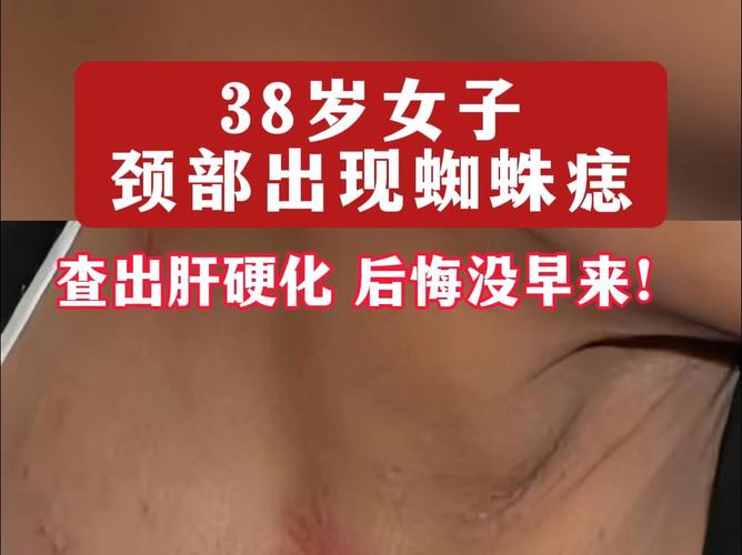 为什么会长红色的痣