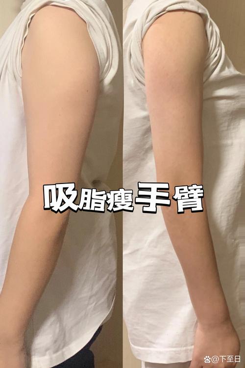 抽脂肪减肥有什么后遗症