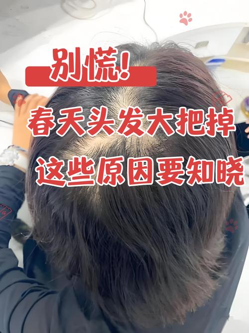 掉头发严重是什么病