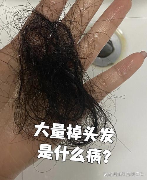 掉头发严重是什么病
