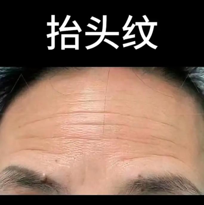 为什么会长抬头纹