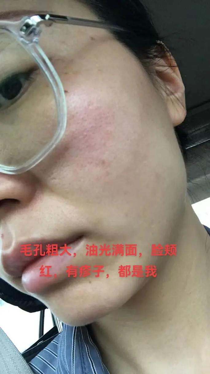 毛孔发红是什么原因