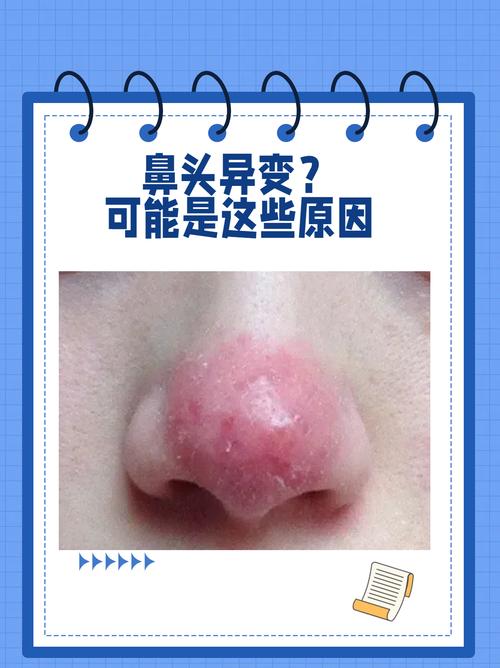 鼻尖红肿是什么原因