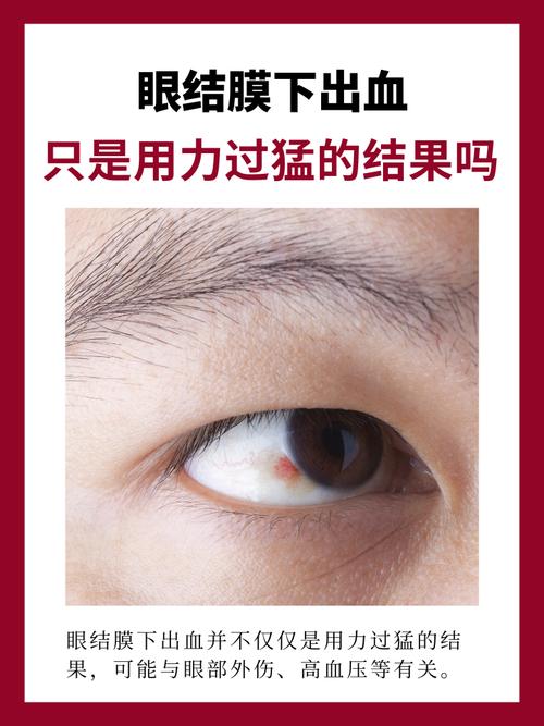 白眼球充血什么原因