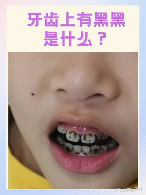 牙齿里面黑的是什么