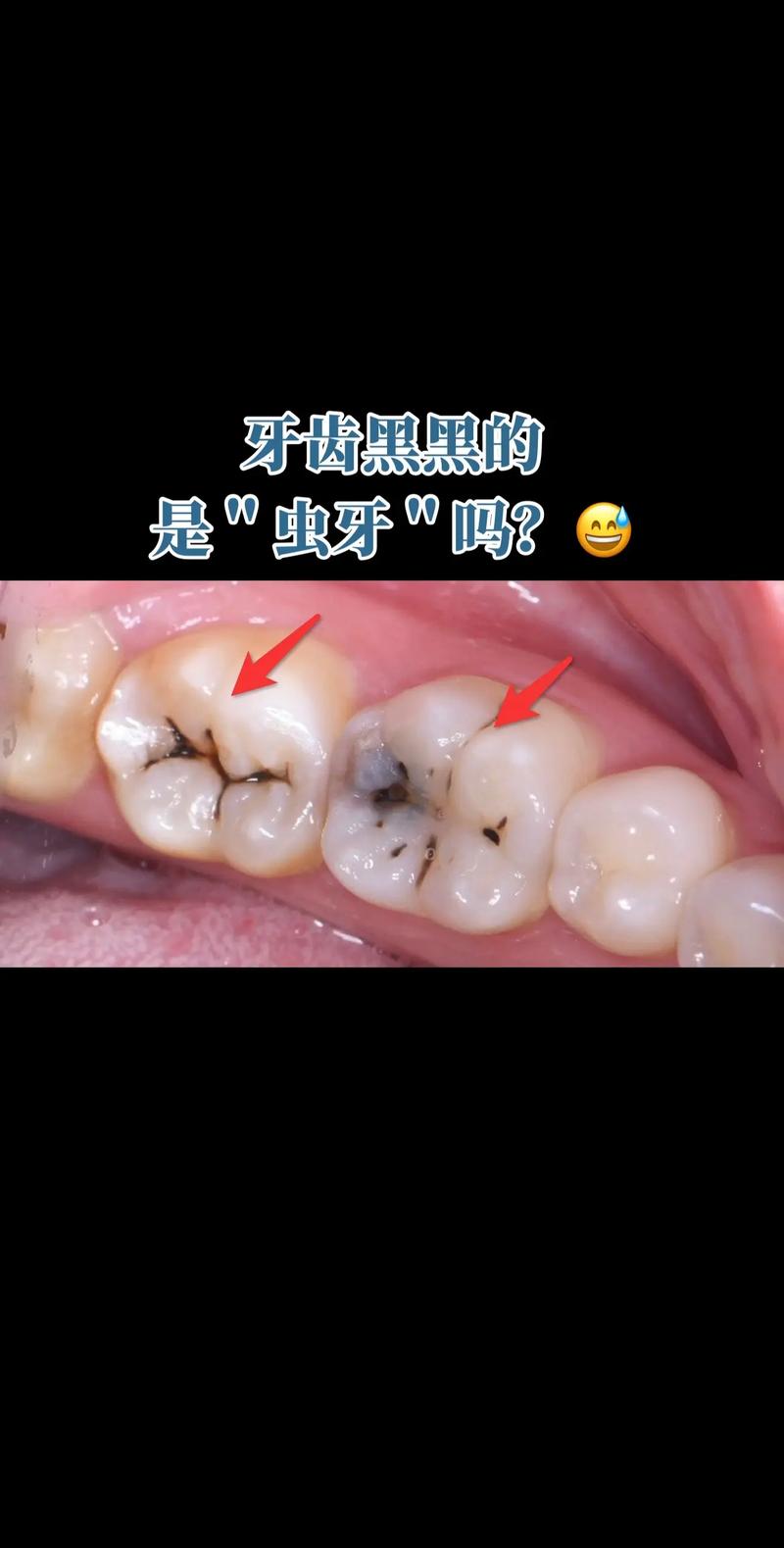 牙齿里面黑的是什么