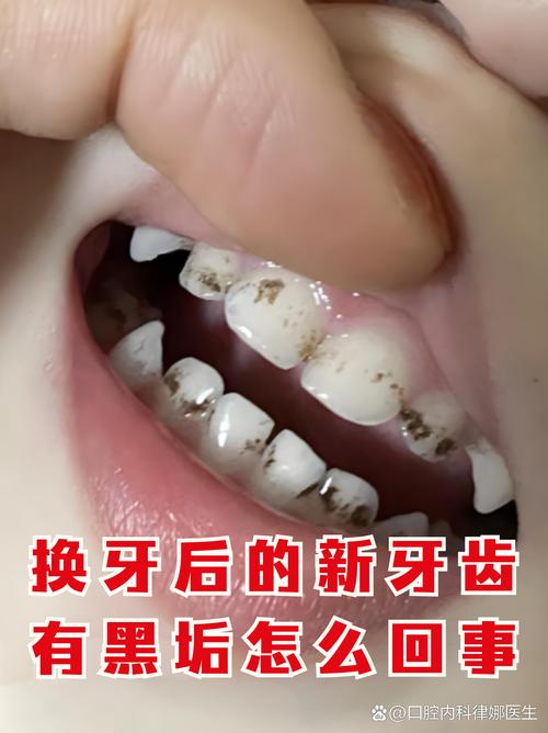 牙齿里面黑的是什么