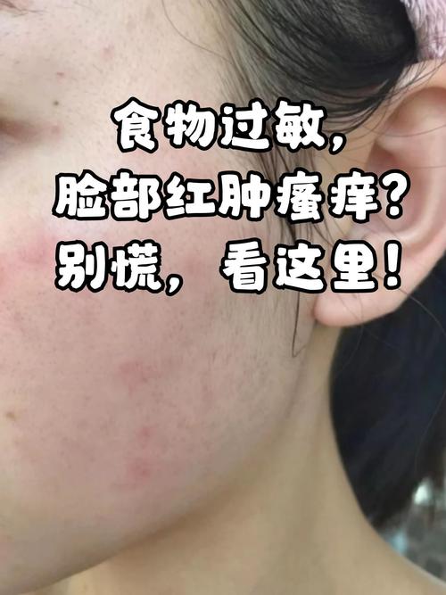 脸部过敏是什么症状