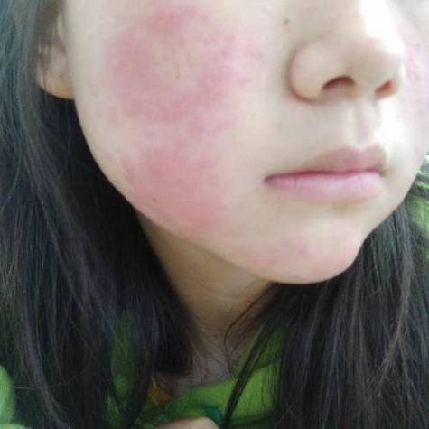 脸部过敏是什么症状