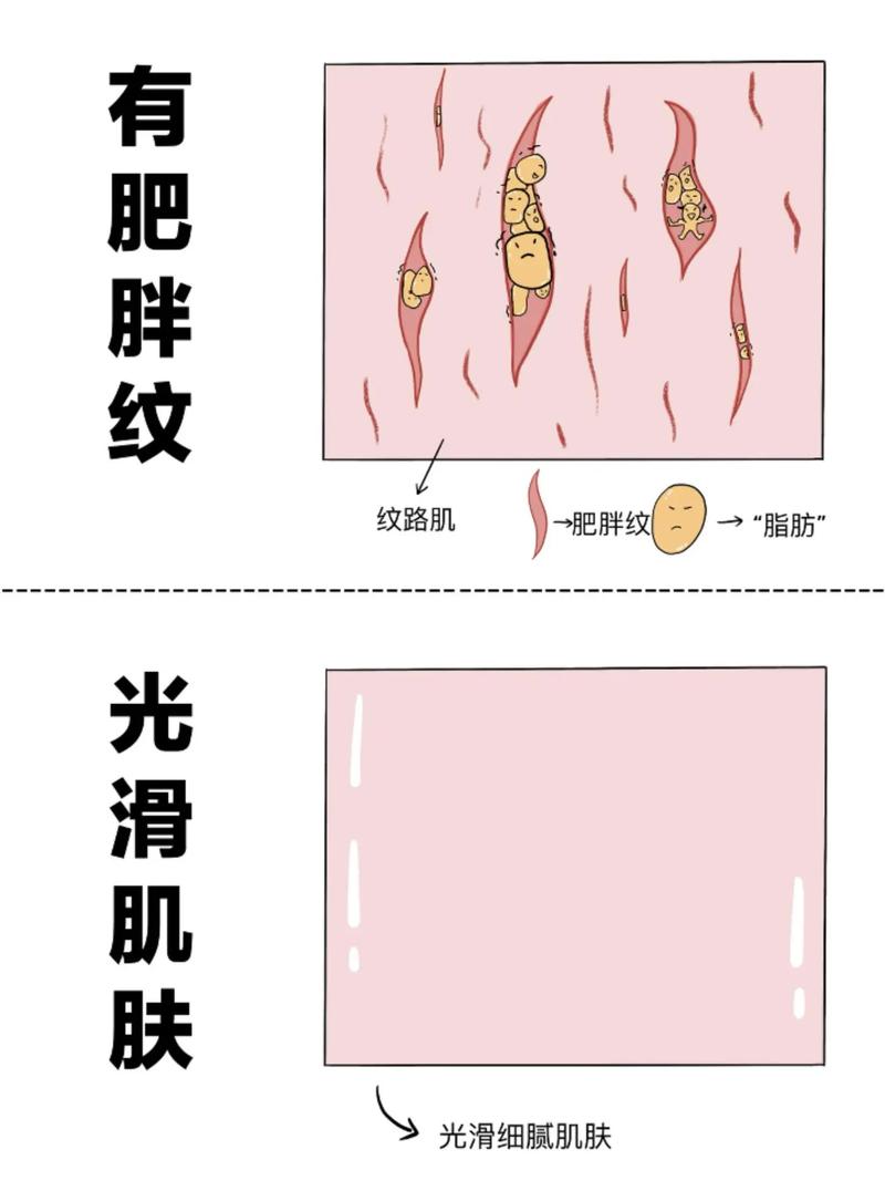 为什么减肥会有减肥纹