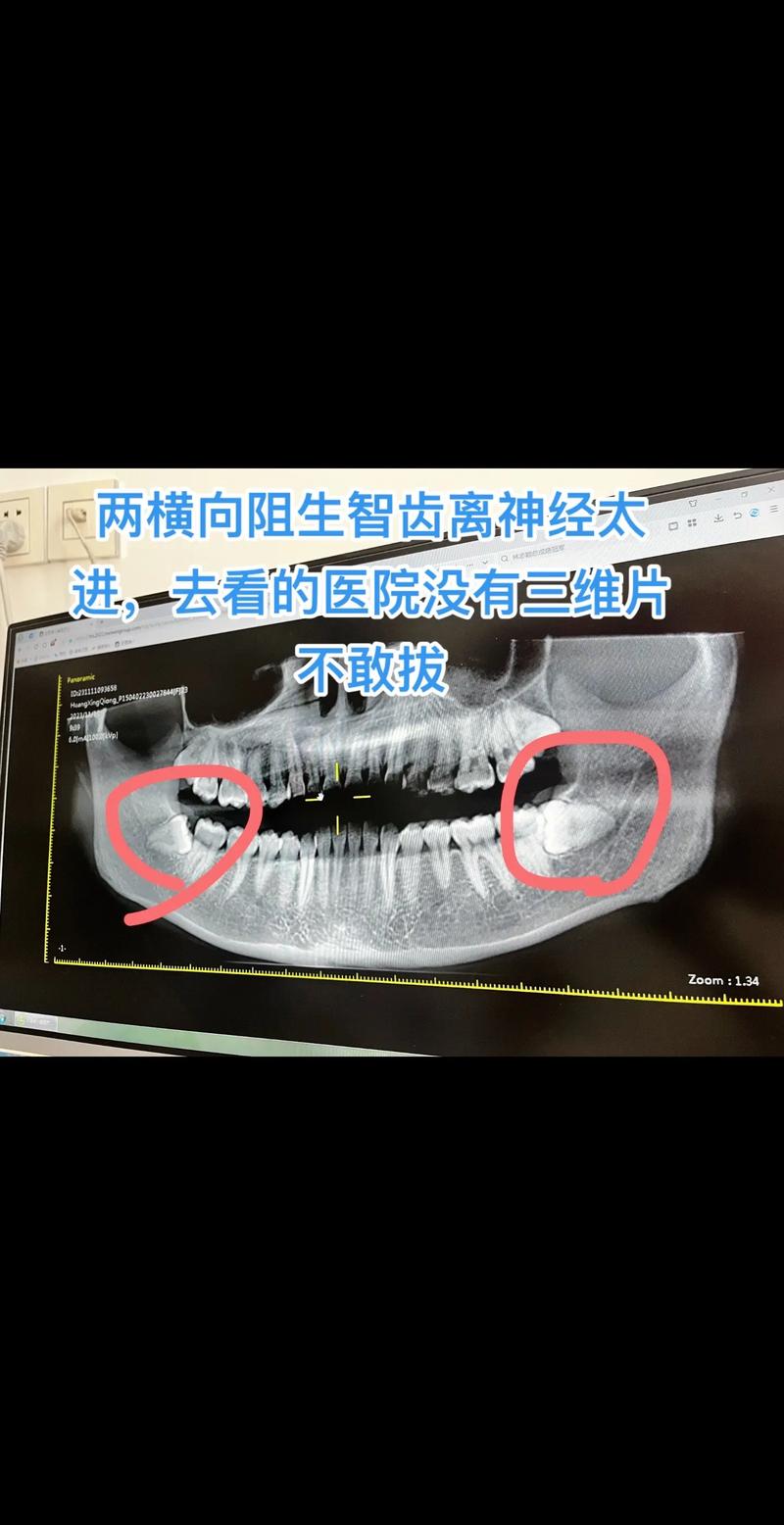 智牙是什么牙