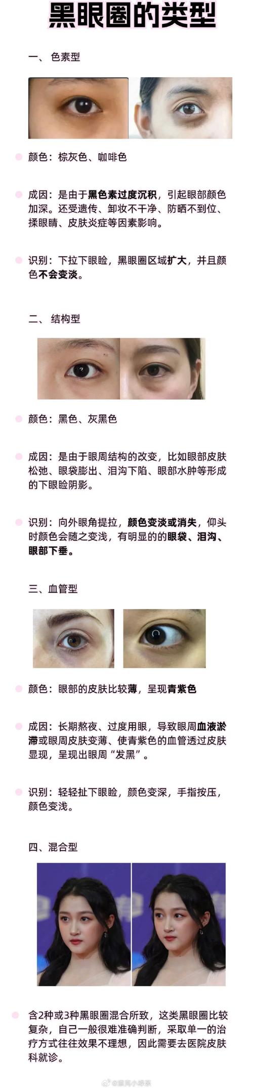 眼袋黑眼圈是什么原因