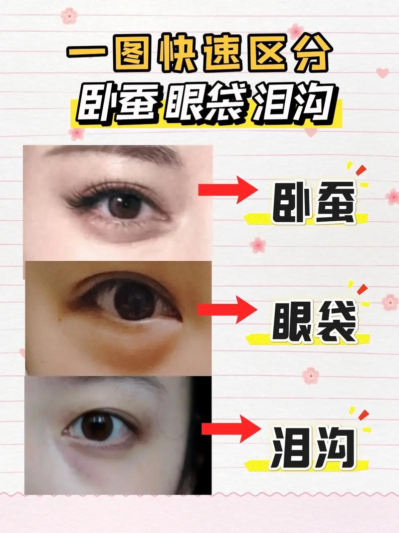 眼袋黑眼圈是什么原因