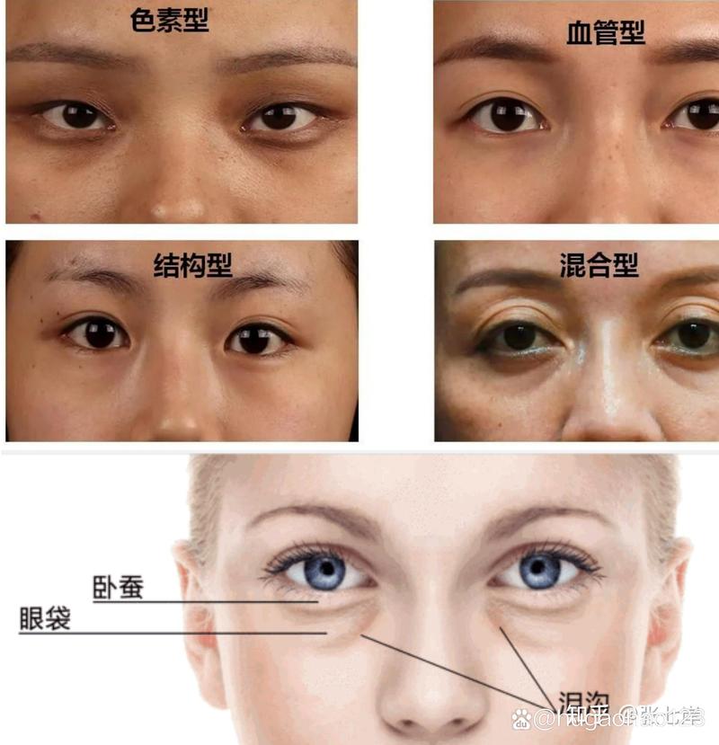 眼袋黑眼圈是什么原因
