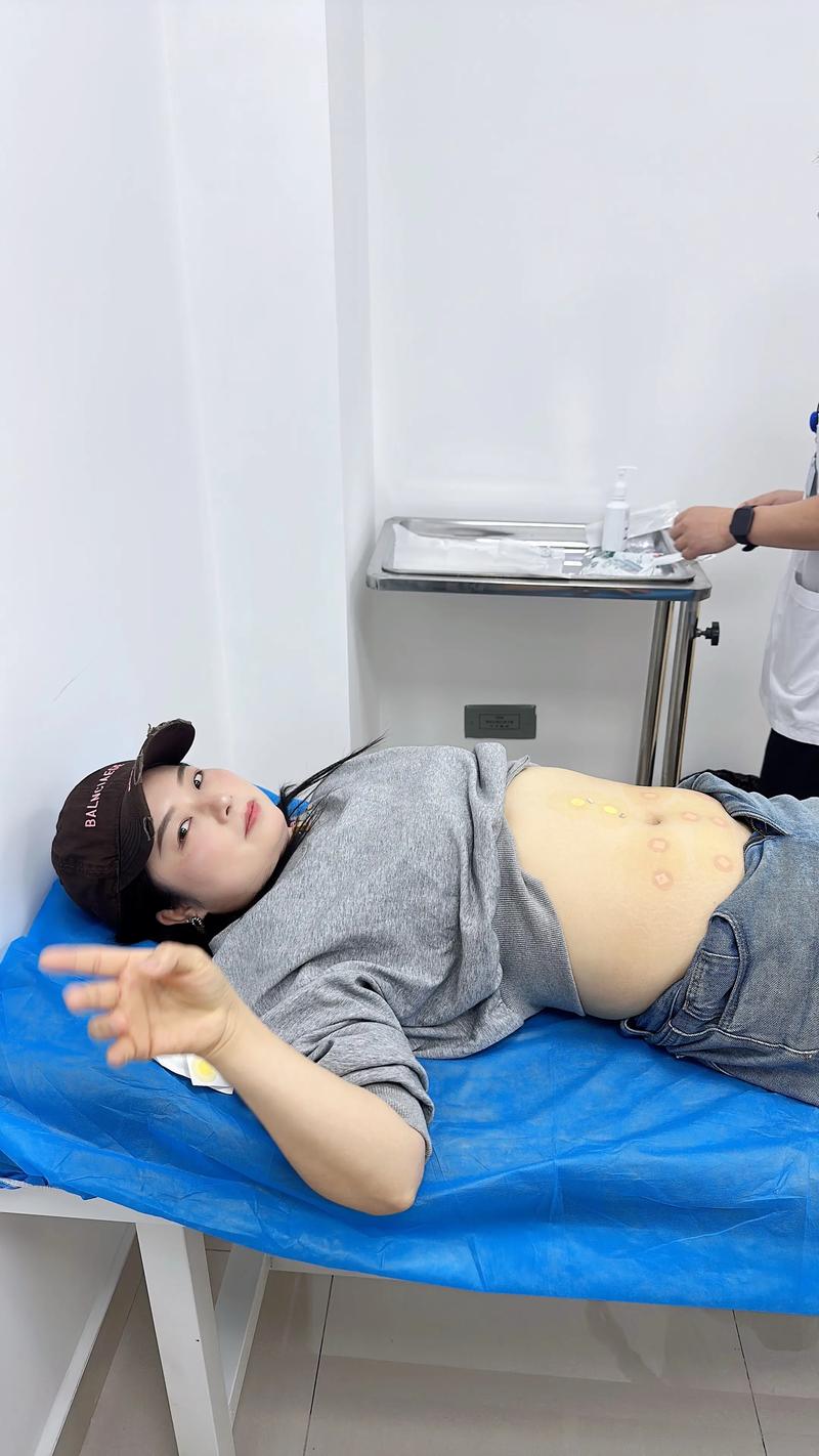 埋线减肥什么症状