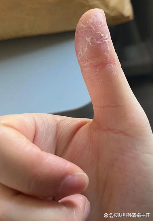 手指头脱皮是缺什么