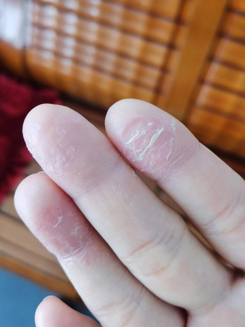 手指头脱皮是缺什么