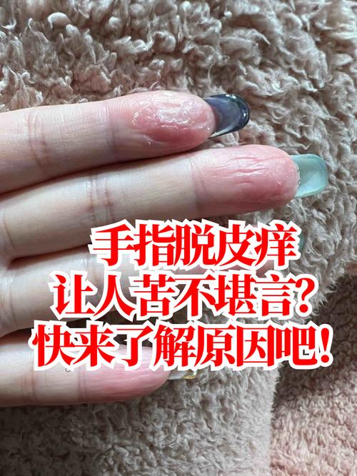 手指头脱皮是缺什么