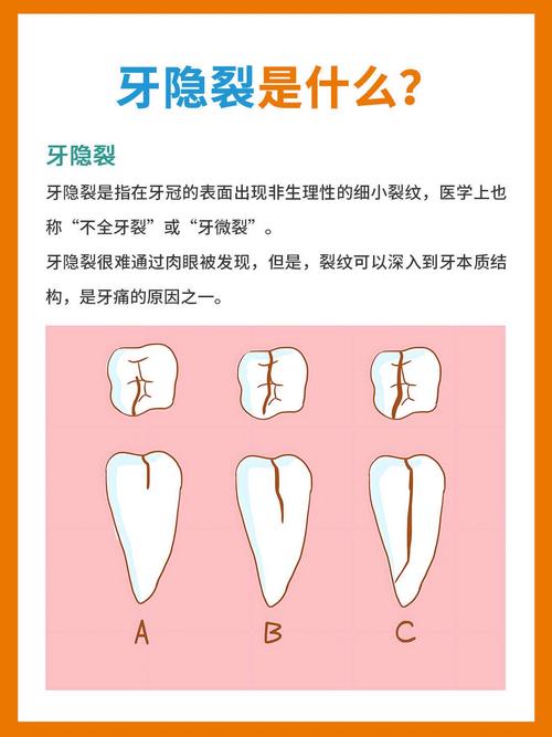 牙齿裂开是什么原因