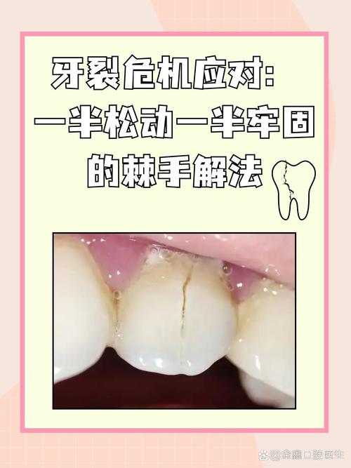 牙齿裂开是什么原因