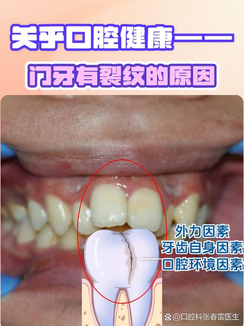 牙齿裂开是什么原因