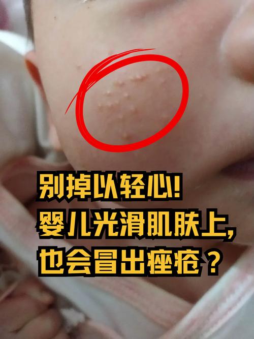 为什么脸上会长粉刺