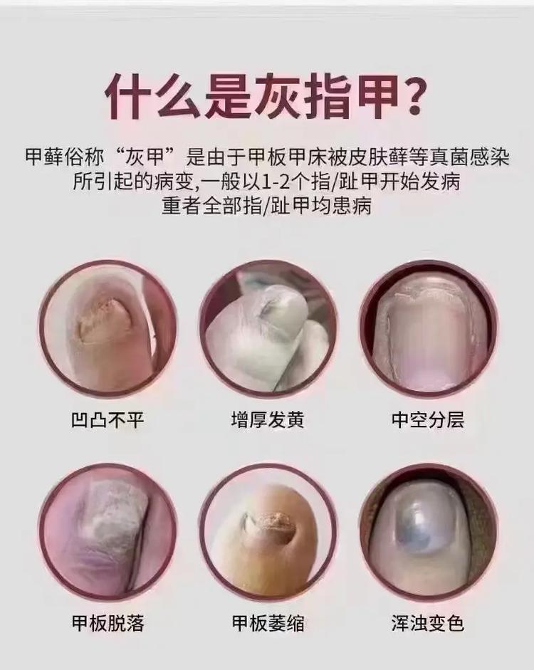 灰指甲是什么颜色的
