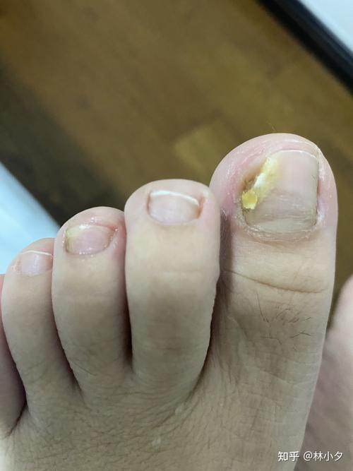 灰指甲是什么颜色的