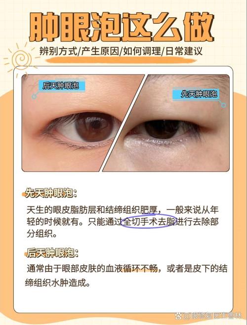 为什么会有肿眼泡