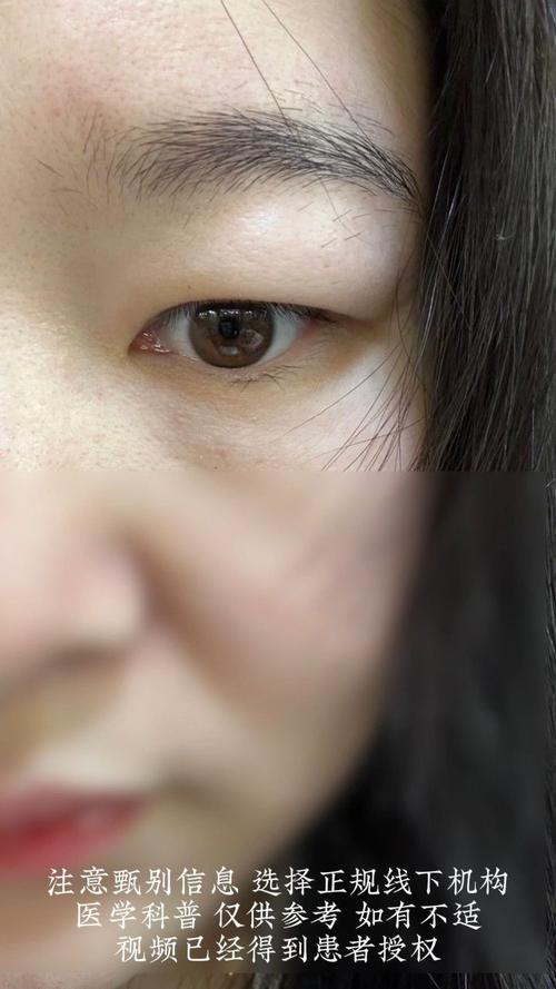 为什么会有肿眼泡