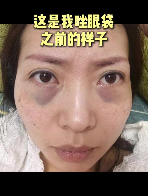 为什么我有眼袋