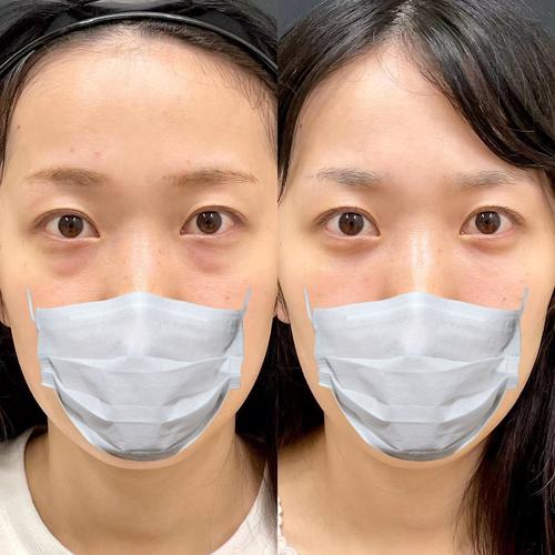 为什么我有眼袋
