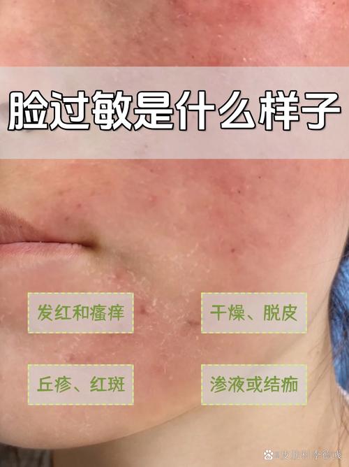 为什么脸上老是过敏