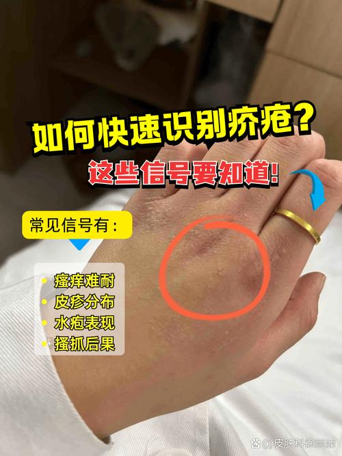 疥疮为什么晚上痒