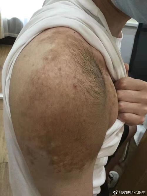 贝克痣是什么