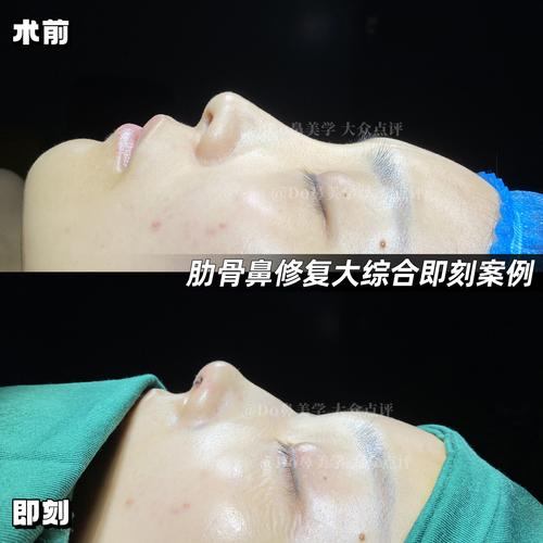 什么是硅胶隆鼻