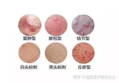 痘痘有脓是什么原因