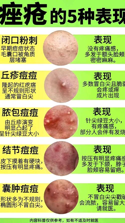 青春痘是什么引起的