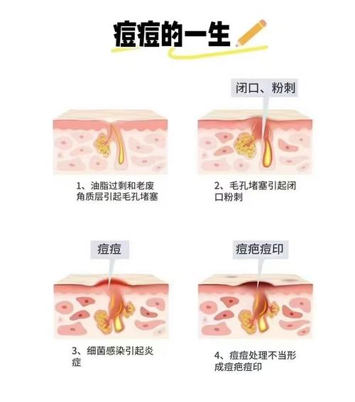 青春痘是什么引起的