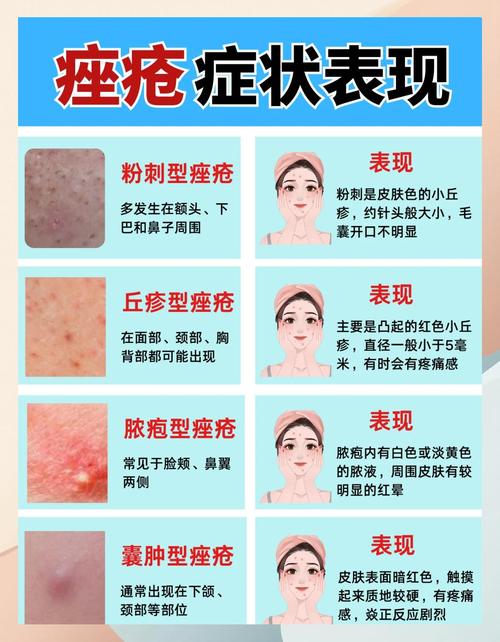 青春痘是什么引起的