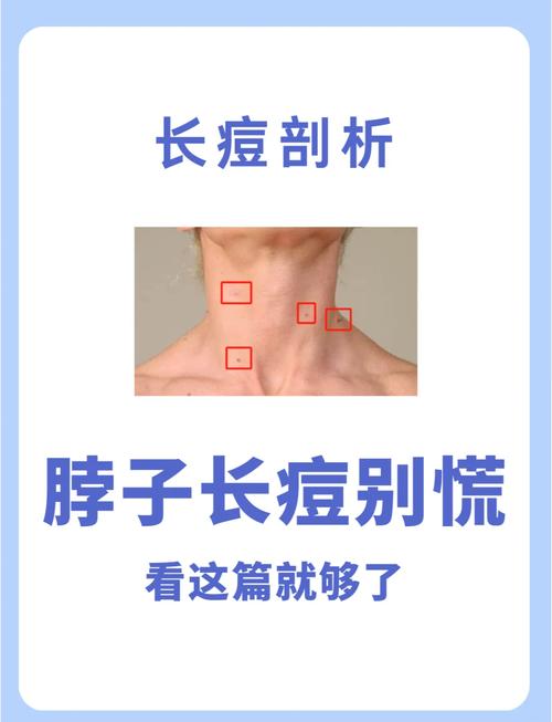 脖子起痘是什么原因