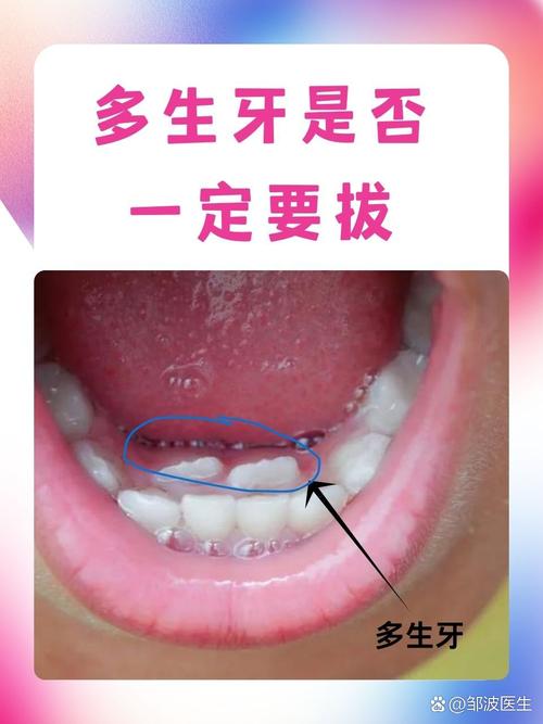 多生牙是什么原因