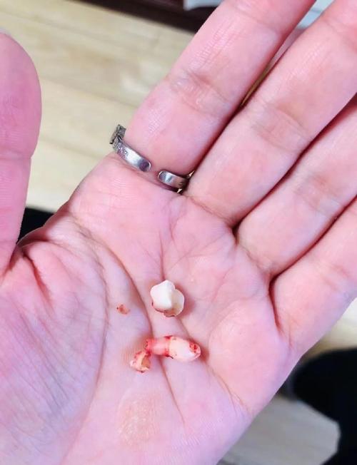 多生牙是什么原因