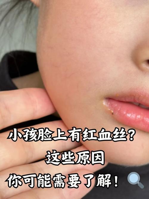脸上为什么有红血丝